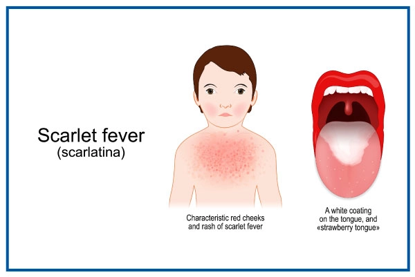 Scarlet Fever